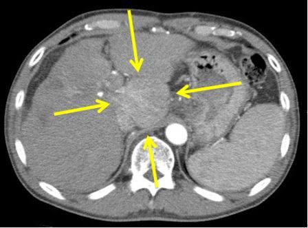 造影CTで肝尾状葉の肝細胞癌が描出されている