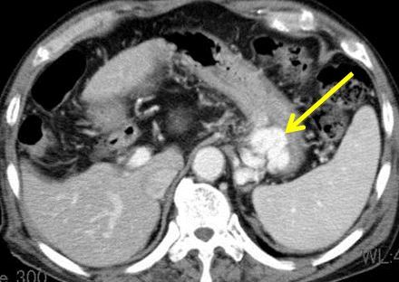 造影CTで胃静脈瘤がみられる（矢印）