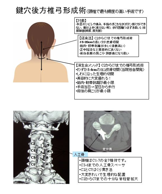鍵穴後方椎弓形成術