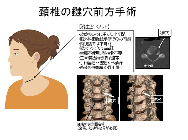 頚椎の鍵穴前方手術