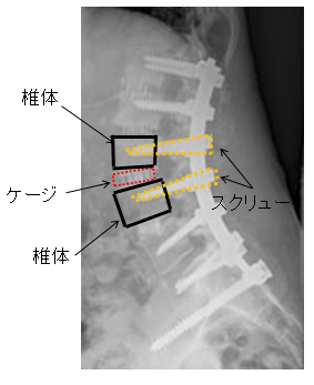 腰椎すべり症に対する腰椎固定術