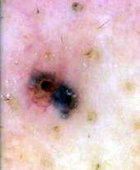 図3：中央の小潰瘍、血管拡張、黒色斑