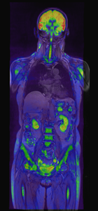 全身腫瘍MRI画像