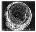 IVUS(血管内超音波)