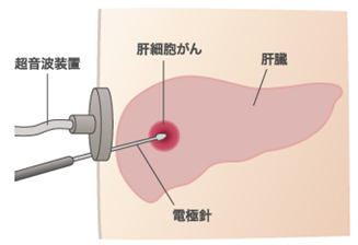 肝がんのラジオ波治療