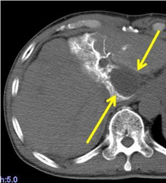 治療後1か月後の肝動脈造影下のCT;腫瘍の造影効果が消失