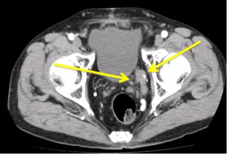 治療後1年後のCT。異常血管は縮小し、血流は消失している