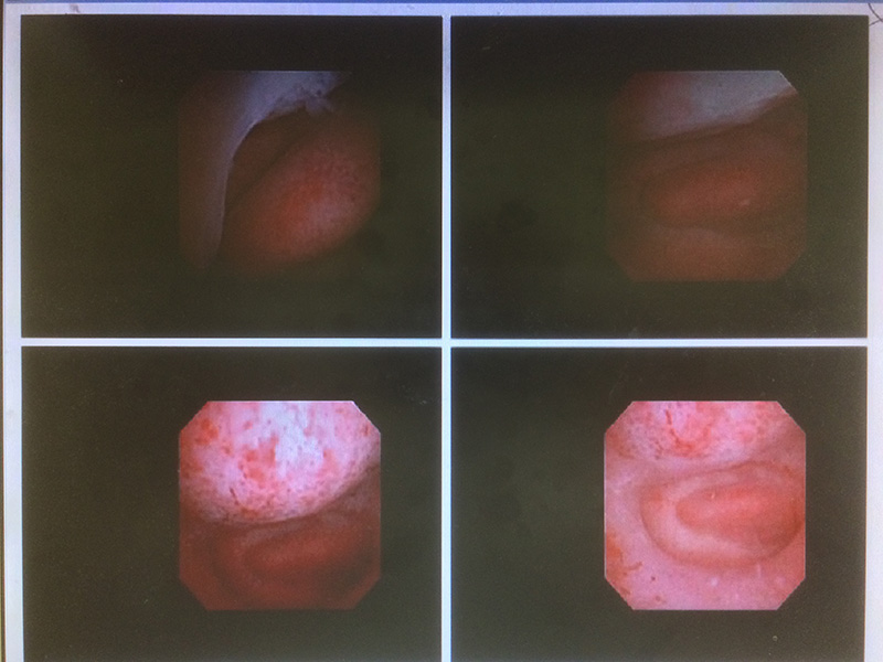 子宮粘膜下筋腫+内膜ポリープ