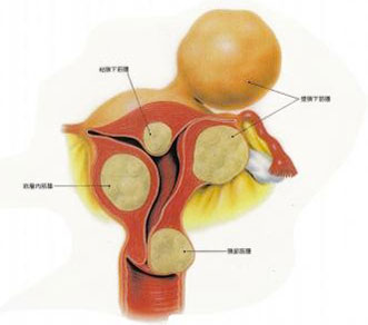 する 小さく 子宮 筋腫