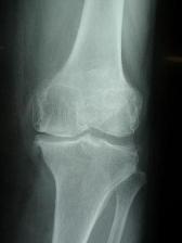 joint_replacement02