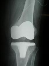 joint_replacement04