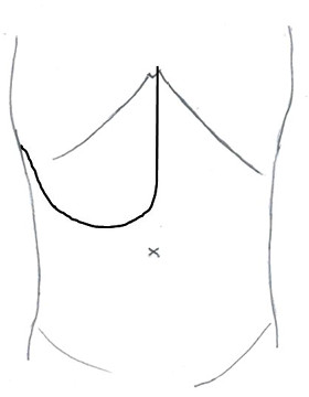 開腹手術