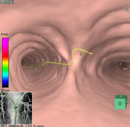 仮想気管支鏡画像