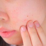 レーザー治療