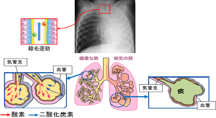 喫煙により肺炎をおこす仕組みのイメージ図