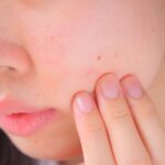 肌荒れを気にする人物のイメージ写真