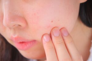 肌荒れを気にする人物のイメージ写真