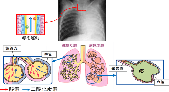 健康な肺 気管支、血管、酸素、二酸化炭素 病気の肺 気管支、血管、痰