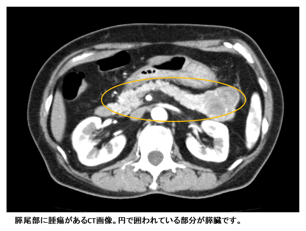 膵尾部に腫瘍があるCT画像。円で囲まれている部分が膵臓です。