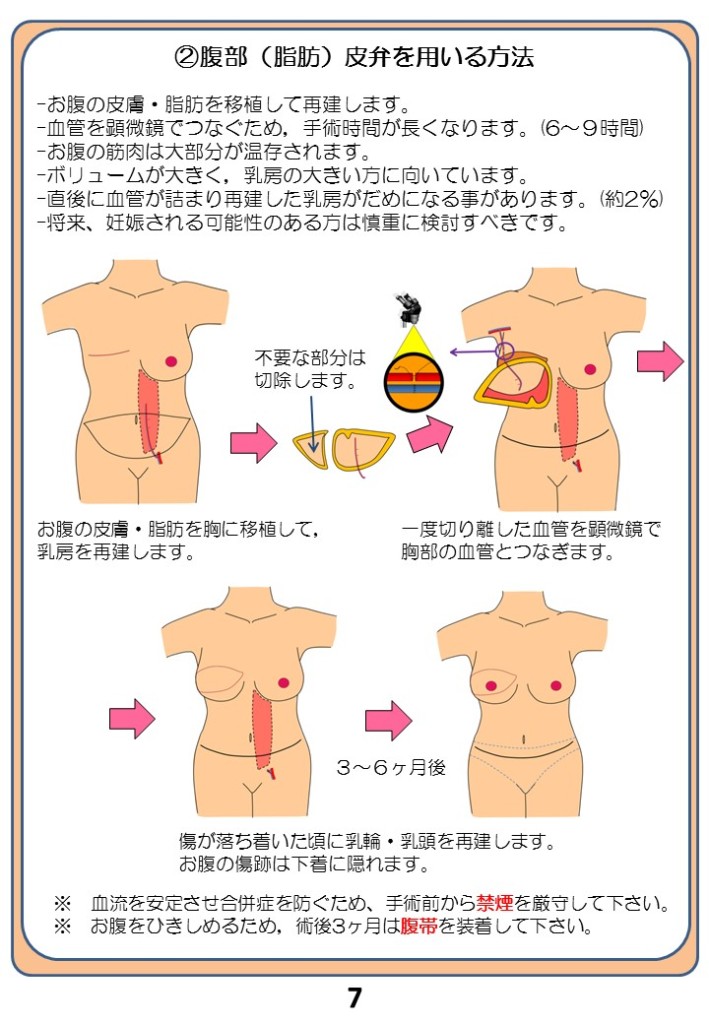 （２）腹部（脂肪）皮弁を用いる方法 - お腹の皮膚・脂肪を移植して再建します。 - 血管を顕微鏡でつなぐ為、手術時間は長くなります。（6～9時間） - お腹の筋肉は大部分で温存されます。 - ボリュームが大きく、乳房の大きい方に向いています。 - 直後に血管が詰まり再建した乳房がダメになることがあります。（約２％） - 将来、妊娠される可能性のある方は慎重に検討すべきです。 不要な部分は切除します。 お腹の皮膚・脂肪を胸に移植して乳房を再建します。 一度切り離した血管を顕微鏡で胸部の血管をつなぎます。 ３～６か月後 傷が落ち着いた頃に乳輪・乳頭を再建します。 お腹の傷跡は下着に隠れます。 ※血流を安定させ合併症を防ぐため、手術前から禁煙を厳守してください。 ※お腹を引き締める為、術後三か月は腹帯を装着して下さい。