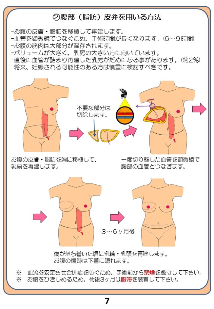 （２）腹部（脂肪）皮弁を用いる方法 - お腹の皮膚・脂肪を移植して再建します。 - 血管を顕微鏡でつなぐ為、手術時間は長くなります。（6～9時間） - お腹の筋肉は大部分で温存されます。 - ボリュームが大きく、乳房の大きい方に向いています。 - 直後に血管が詰まり再建した乳房がダメになることがあります。（約２％） - 将来、妊娠される可能性のある方は慎重に検討すべきです。 不要な部分は切除します。 お腹の皮膚・脂肪を胸に移植して乳房を再建します。 一度切り離した血管を顕微鏡で胸部の血管をつなぎます。 ３～６か月後 傷が落ち着いた頃に乳輪・乳頭を再建します。 お腹の傷跡は下着に隠れます。 ※血流を安定させ合併症を防ぐため、手術前から禁煙を厳守してください。 ※お腹を引き締める為、術後三か月は腹帯を装着して下さい。