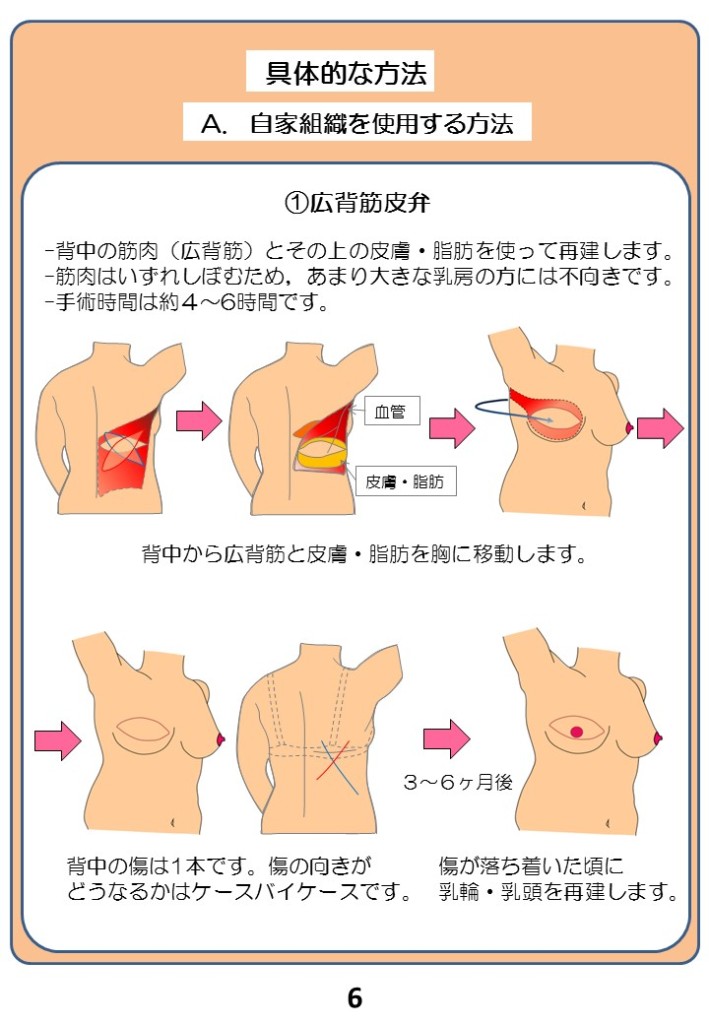 具体的な方法
A.自家組織を使用する方法
（１）広背筋皮弁
- 背中の筋肉（広背筋）とその上の皮膚・脂肪を使って再建します。
- 筋肉はいずれはしぼむため、あまり大きな乳房の方には不向きです。
- 手術時間は約4～６時間です。
・血管・皮膚・脂肪
背中から広背筋を皮膚・脂肪を胸に移動します。
３～６か月後
背中の傷は１本です。傷の向きがどうなるかはケースバイケースです。
傷が落ち着いた頃に乳輪・乳頭を再建します。