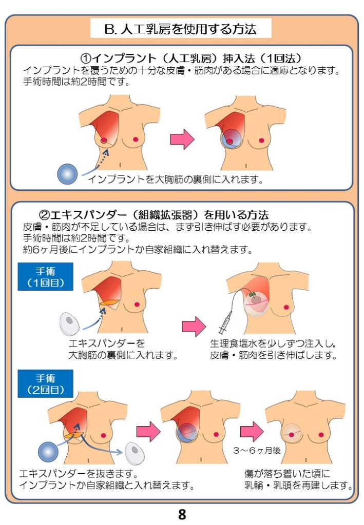 B.人口乳房を使用する方法 （１）インプラント（人口乳房）挿入法（１回法） インプラントを覆う為の十分な皮膚・筋肉がある場合に適応となります。 手術時間は約２時間です。 インプラントを大胸筋の裏側に入れます。 （２）エキスパンダー（組織拡張器）を用いる方法 皮膚・筋肉が不足している場合は、まず引き伸ばす必要があります。 手術時間は約２時間です。 約６か月後にインプラントか、自家組織に入れ替えます。 手術一回目 ・エキスパンダーを大胸筋の裏側に入れます。 ・生理食塩水を少しずつ注入し、皮膚・筋肉を引き伸ばします。 手術２回目 ・エキスパンダーを抜きます。インプラントか自家組織を入れ替えます。 ３～６か月後 ・傷が落ち着いた頃に乳輪・乳頭を再建します。