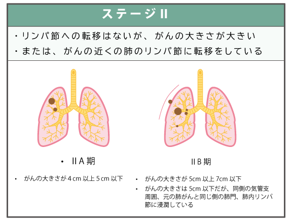 ステージⅡの肺がんイメージ