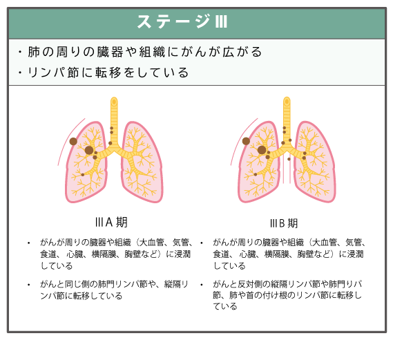 ステージⅢの肺がんイメージ