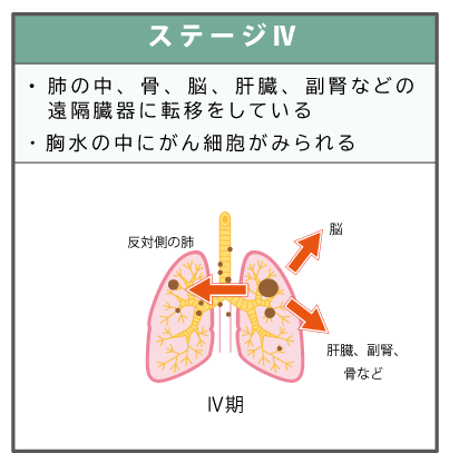 ステージⅣの肺がんイメージ