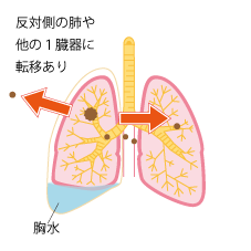 反対側の肺や他の１臓器に転移あり 胸水