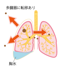 多臓器に転移あり 胸水