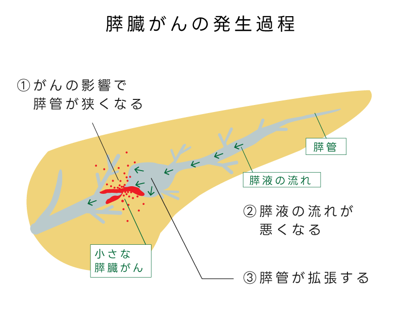 ①がんの影響で膵管が狭くなる ②膵液の流れが悪くなる ③膵管が拡張する 膵管・膵液の流れ・小さな膵臓がん