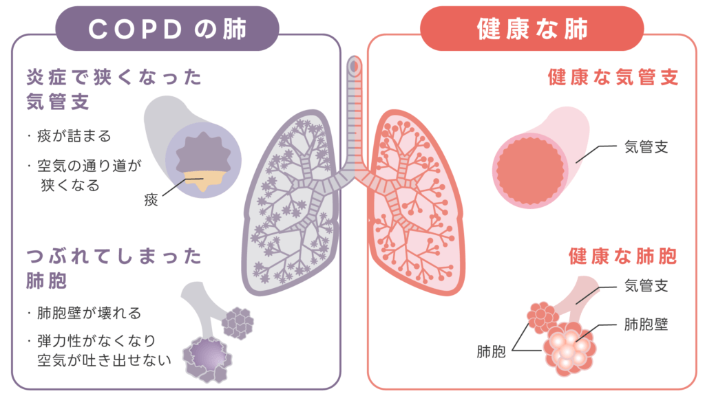 COPDのイメージ図