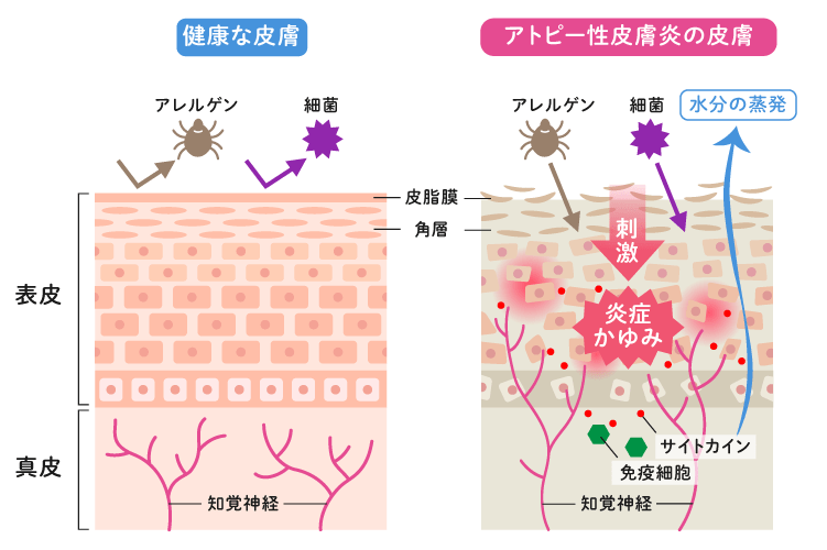 健康な皮膚とアトピー性皮膚炎の皮膚の断面図イメージ