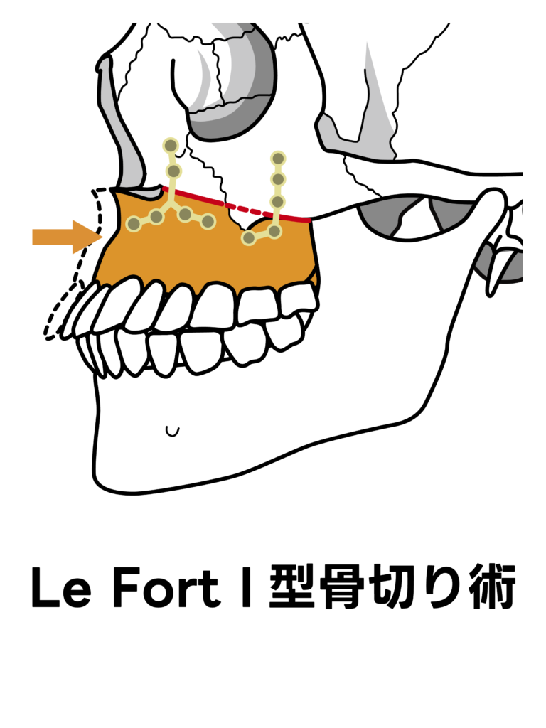 Le Fort Ⅰ型骨切術のイメージ図