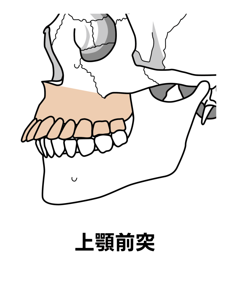上顎前突のイメージ図
