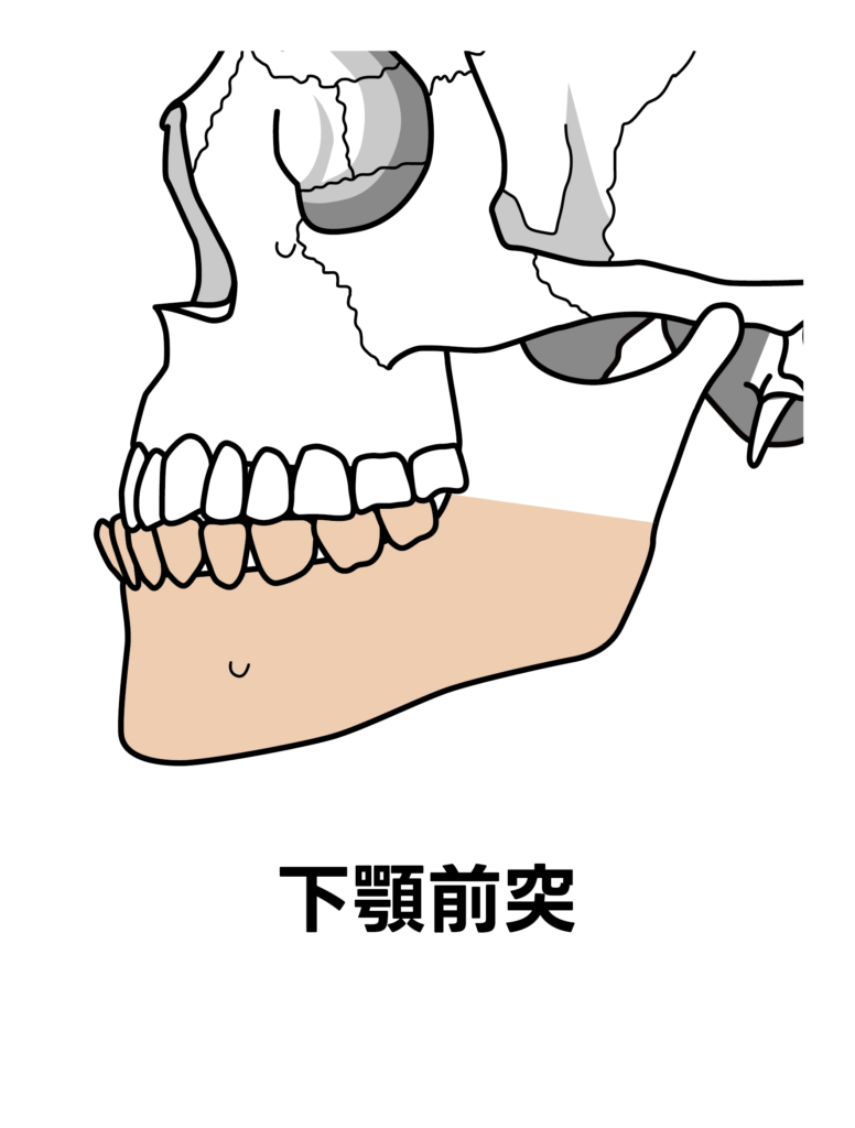 下顎前突のイメージ図