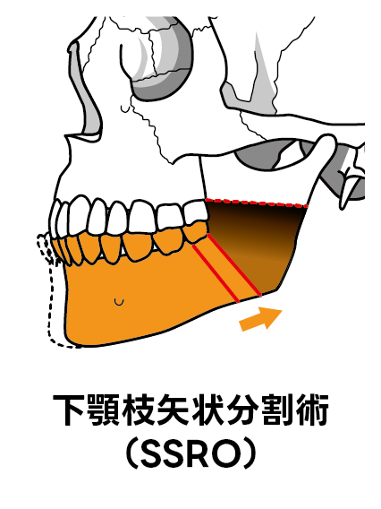 下顎枝矢状分割術（SSRO）のイメージ図