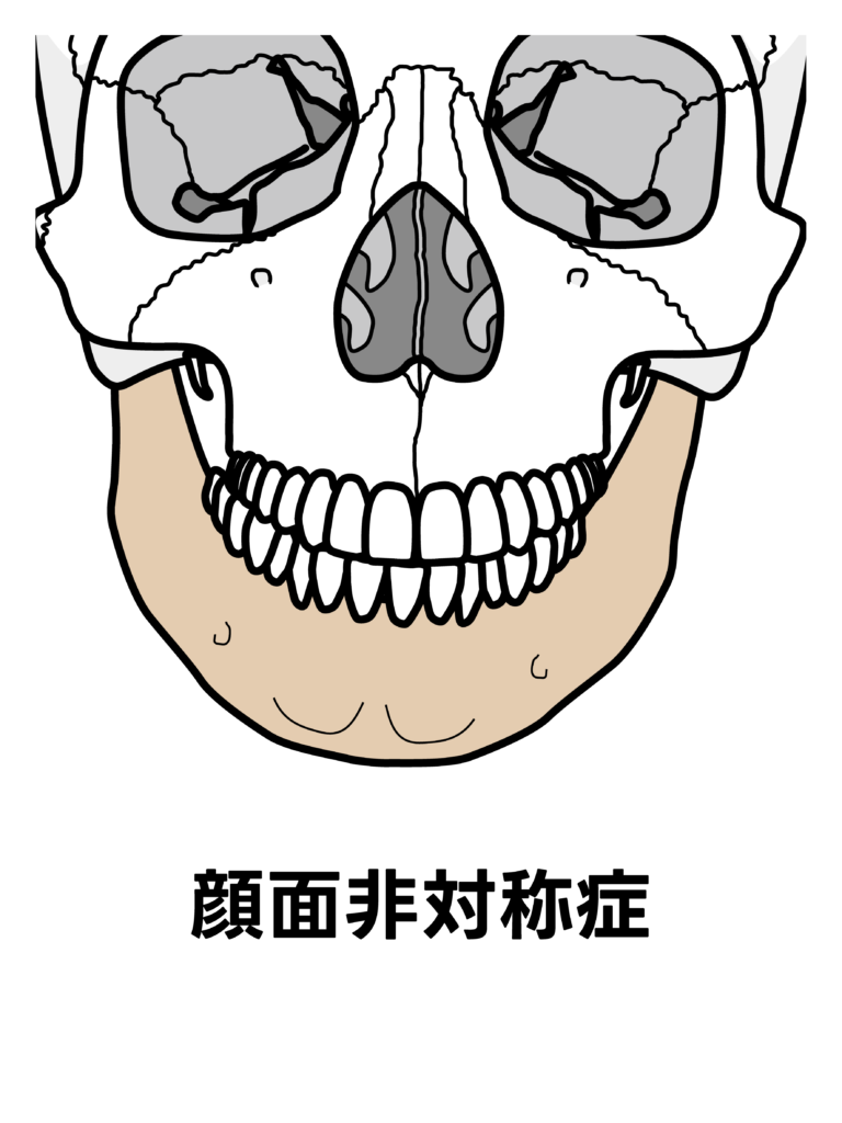 顔面非対称症のイメージ図