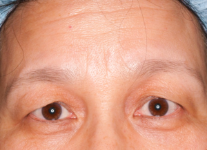 眼瞼下垂（手術前）の写真