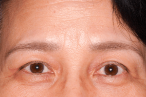 眼瞼下垂（手術後）の写真