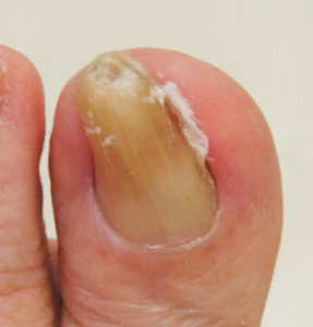 巻き爪のワイヤー矯正（治療前）の写真①