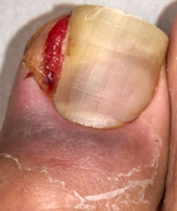 陥入爪のワイヤー矯正（治療前）の写真