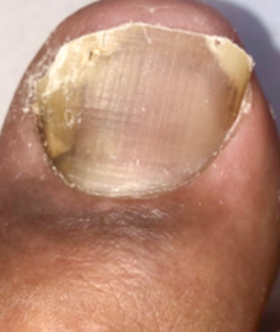 陥入爪のワイヤー矯正（治療後）の写真