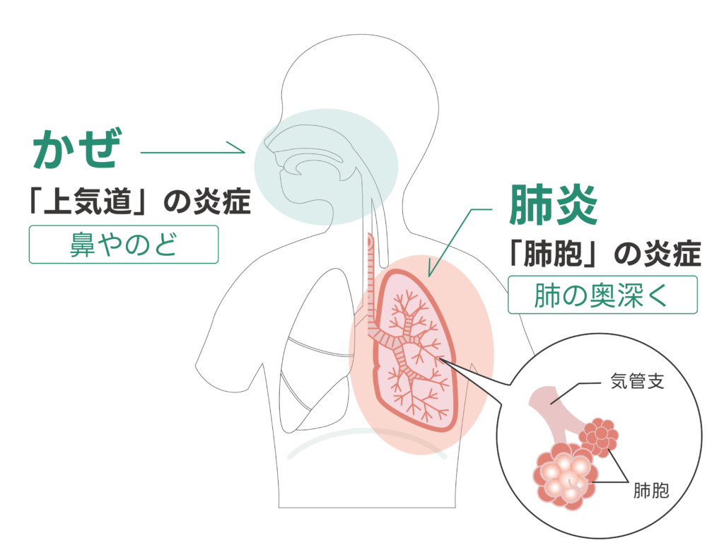 風邪と肺炎の炎症場所の違いの図