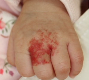 症例：乳児血管腫（いちご状血管腫）1か月後