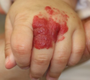 症例：乳児血管腫（いちご状血管腫）4か月後