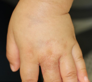 症例：乳児血管腫（いちご状血管腫）6か月後