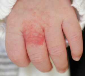 症例：乳児血管腫（いちご状血管腫）初診時